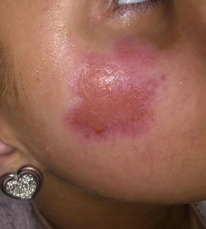 amie hall poparzenie