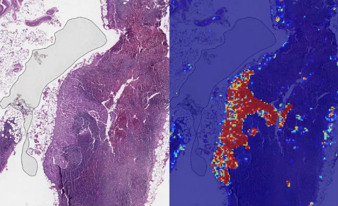 Sztuczna inteligencja od Google wykrywa zaawansowanego raka lepiej od ludzi